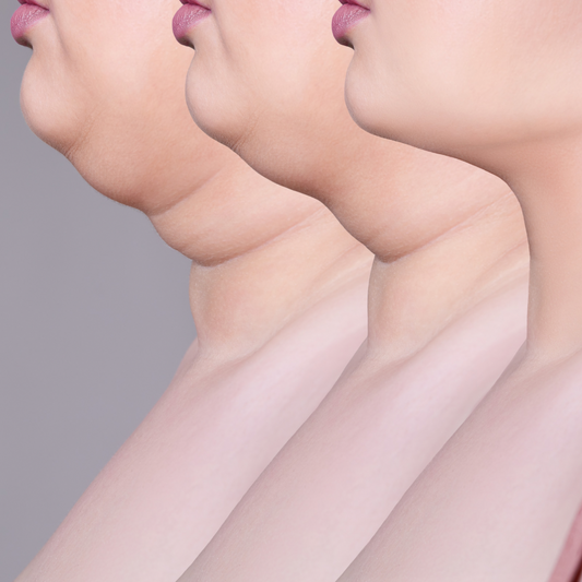 Chin & Neck Fat Reduction and Skin Tightening